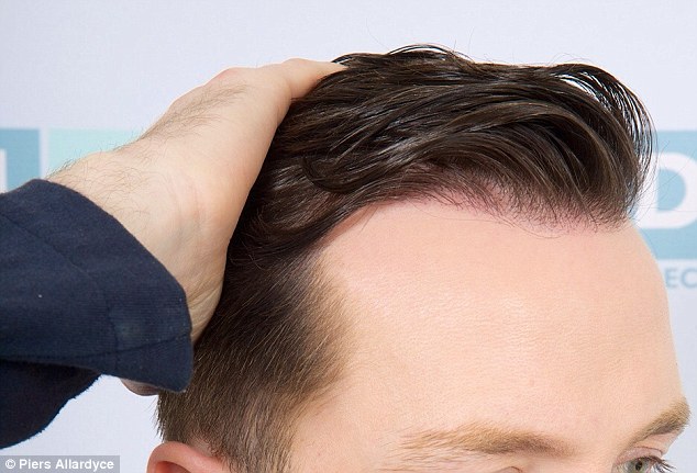 how to regrow hairs on bald patches